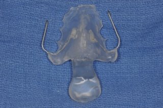 C:\Users\aSuS\Desktop\Interim_Palatal_Lift_Prosthesis.jpg