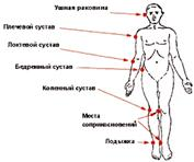 Пролежни