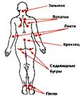 Пролежни
