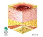 http://www.stoppain.org/pressureulcers/common/img/NPUAP-Stage2.jpg