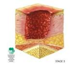http://www.stoppain.org/pressureulcers/common/img/clip_image016.jpg