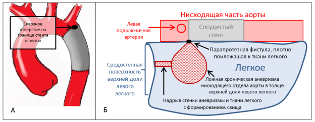 Схема разрыва стенки хронической постоперационной ложной аневризмы нисходящего отдела аорты в ткань легкого и плевральную полость: вид спереди (А) и сверху (Б)