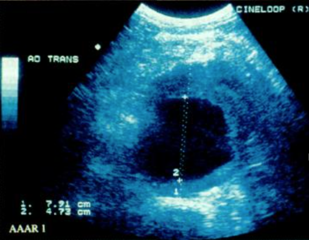 Аневризма инфраренального отдела аорты. Поперечное ультразвуковое сканирование в В-режиме [7, с. 27]