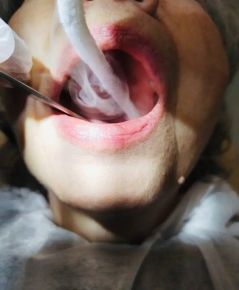 Процедура криодеструкции гипертрофированных гранул