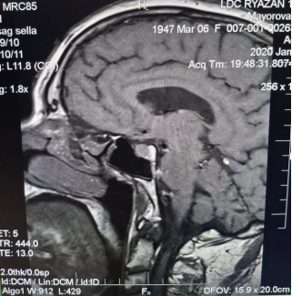 МРТ головного мозга (T1 sag sella)