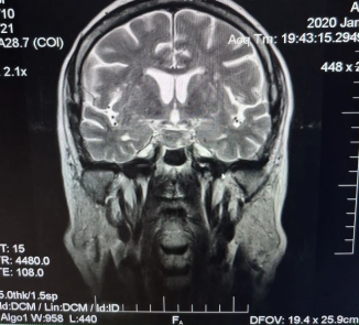 МРТ головного мозга (T2 Cor)