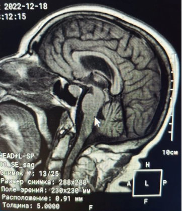 МРТ головного мозга (T1 SE sag)