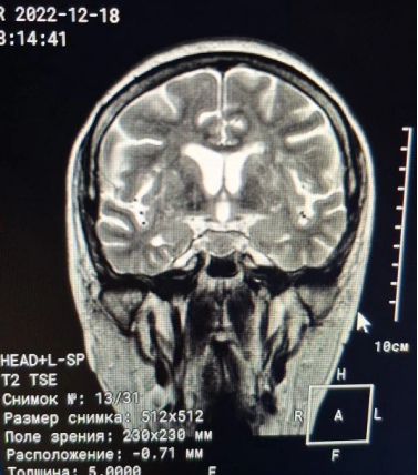 МРТ головного мозга (T2 TSE)
