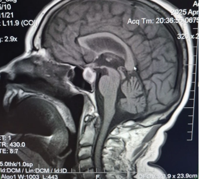 МРТ головного мозга (T1 SE sag)