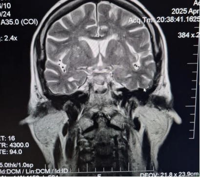 МРТ головного мозга (T2 Cor)
