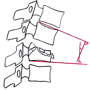 Схема расчета угла кифотической деформации по данным спондиллографии