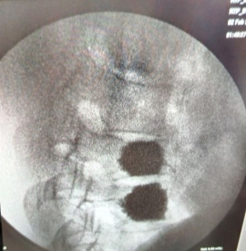 Компрессионный перелом Тн11 позвонка с выполнением вертебропластики Тн11 и Тн12 позвонков. Угол кифотической деформации сохранен до 15 градусов по УКД, компрессия 1 степени
