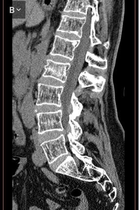 Компрессионный перелом L2 позвонка с болевым синдромом. Компрессия 1 степени без изменения кифотического угла