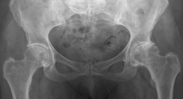 Коксартроз 1 стадии [2]