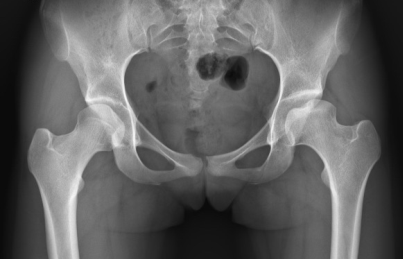 Этап восстановления левого тазобедренного сустава