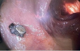 Инородное тело (осколок гранаты) в стенке сигмовидной кишки, перфоративное отверстие после его эндоскопического удаления