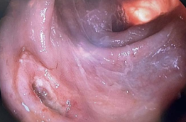 Инородное тело (осколок гранаты) в стенке сигмовидной кишки, перфоративное отверстие после его эндоскопического удаления