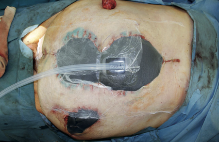 Окончательный вид установленной VAC-системы на лапаротомную рану