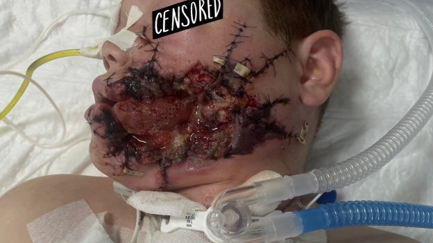 Пациент Ш., 12 лет. Выраженные повреждения мягких тканей лица