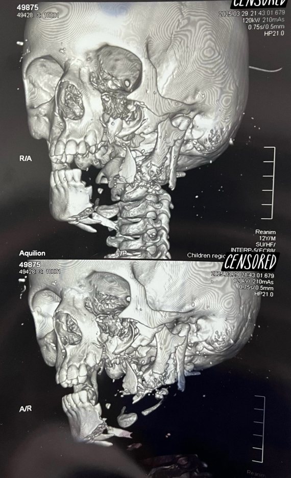Пациент Ш., 12 лет. Компьютерная томография, 3D реконструкция