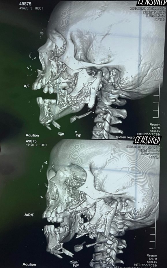 Пациент Ш., 12 лет. Компьютерная томография, 3-D реконструкция