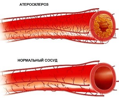 http://proinsultmozga.ru/wp-content/uploads/2017/03/ateroskleroz-2.jpg