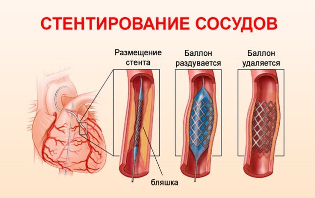 https://mirkardio.ru/wp-content/uploads/2017/10/simptomy-predynfarktnoe-sostoyanie_4.jpg