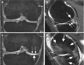 Описание: Fig. 3 Cartilage loss in a patient with baseline meniscal tears in the right knee. ( A ) Coronal DESS MRI at baseline shows normal cartilage at the medial tibiofemoral joint. ( B ) Sagittal intermediate- weighted fat-suppressed MRI at baseline shows a horizontal tear of the posterior horn of the medial meniscus ( small arrows ) with small subchondral femoral bone marrow lesion ( large arrow ). ( C ) Coronal DESS MRI at two-year follow-up shows dramatic cartilage loss at both the weight- bearing medial femur ( small arrows ) and the tibia ( large arrow ), which is confirmed on ( D ), the sagittal intermediate- weighted fat-suppressed MRI. In addition, there are extensive tibial and femoral subchondral bone marrow lesions ( large arrows ) and new joint effusion ( asterisk ). Also, a slight increase in the size of the anterior femoral and tibial osteophytes is observed ( small arrows ) 
 