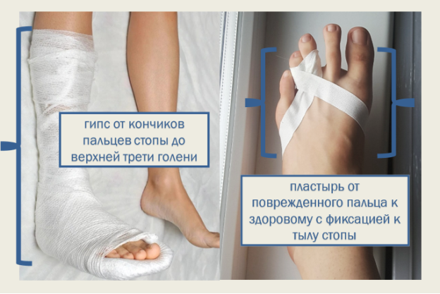 Гипсовая и пластырная фиксации