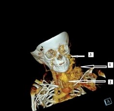 СКТ шеи с болюсным контрастным усилением (БКУ), 3D реконструкция. Примечание: 1 — клубок расширенных и извитых сосудов; 2 — расширенная левая яремная вена; 3 — расширенная левая лицевая вена