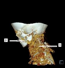 СКТ шеи с болюсным контрастным усилением (БКУ), 3D реконструкция. Примечание: 1 — клубок расширенных и извитых сосудов; 2 — расширенная левая яремная вена; 3 — расширенная левая лицевая вена