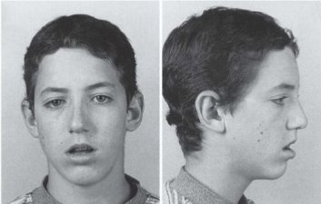 Аденоидный тип лица