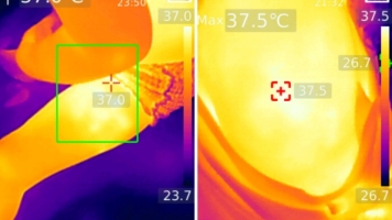 Область ноги ребенка после введения вакцины менактра и область плеча взрослого после введения вакцины от кори