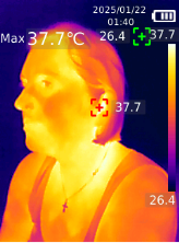 Ушная боль на термограмме