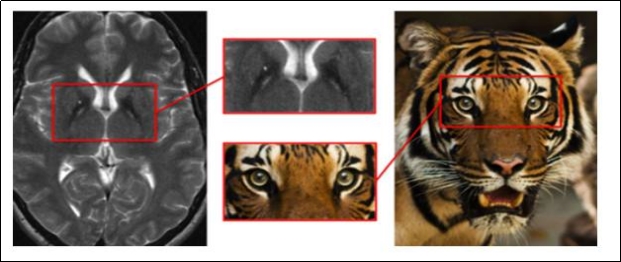 МРТ при ННЖМ-1. Отложение железа в бледном шаре с симптомом «глаза тигра» (стрелки)