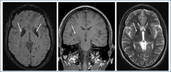 МРТ пациентки П. Симметричное поражение бледных шаров (отложение меди), уменьшение в объеме лентикулярных ядер