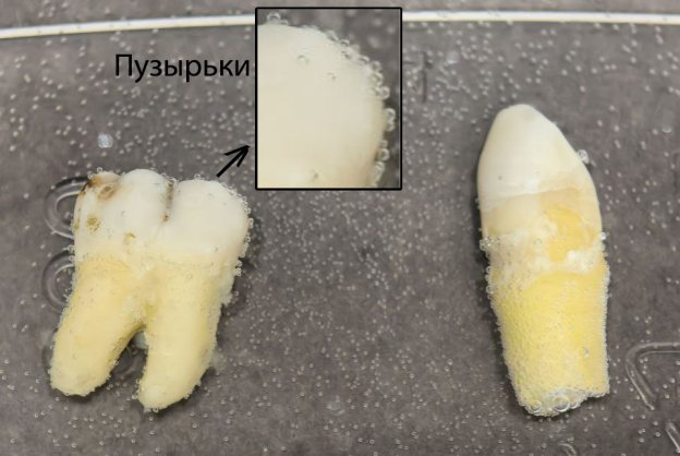 Изображение нечищеного пастой зуба (слева) и предварительно почищенного пастой зуба (справа), которые находились в столовом уксусе 10 минут. На чищенной поверхности эмали практически нет пузырьков