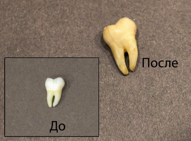Изображение окрасившегося зуба, который был извлечен из колы после 30 мин